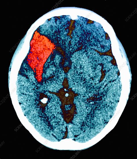 Stroke Ct Scan Stock Image M1360139 Science Photo Library