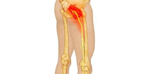 How To Get Out Of Bed With Piriformis Syndrome