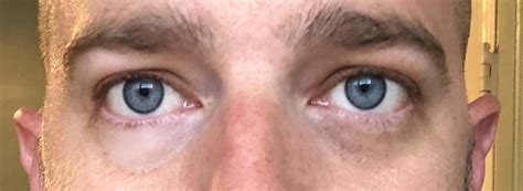 Skin Concerns My Husbands Under Eyes Are Both Discolored But In