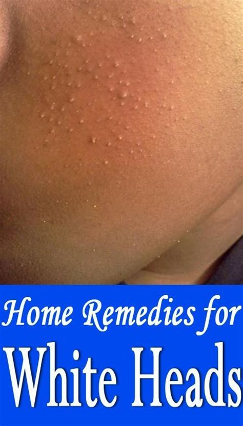 How To Get Rid Of Whiteheads 10 Best Home Remedies Homemade Face