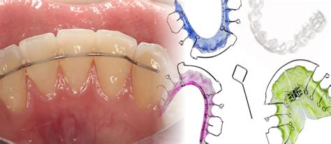 How long to wear retainers after braces off. How long should you wear retainers after getting braces ...