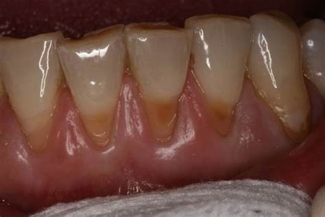 Erosion Of Teeth At Gum Line Tooth Colored Bonding Before And After
