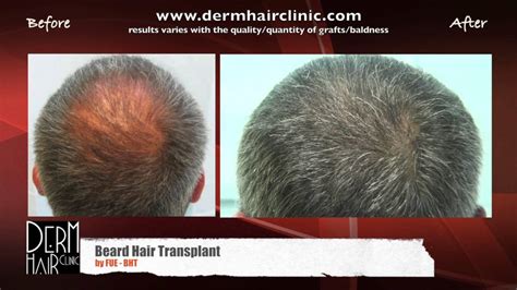 Incredibly Natural Hair Transplant Results Using Beard Hair Youtube