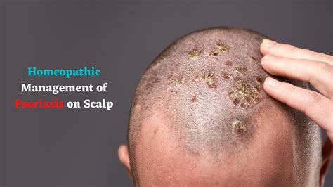 Update 71 Scalp Psoriasis Hair Loss Super Hot Ineteachers