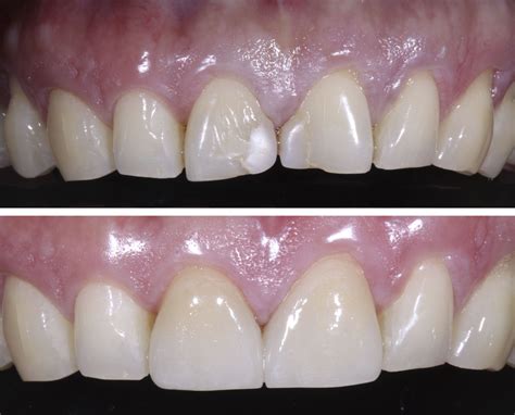 Before And After Patient Had Old Composite Fillings On The Two Front