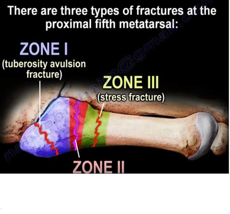 Jones Fracture Of The 5th Metatarsal —