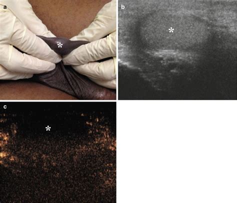 Scrotal Masses Abdominal Key