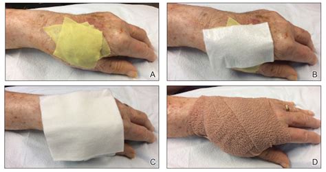 24 7 Dressing Technique To Optimize Wound Healing After Mohs