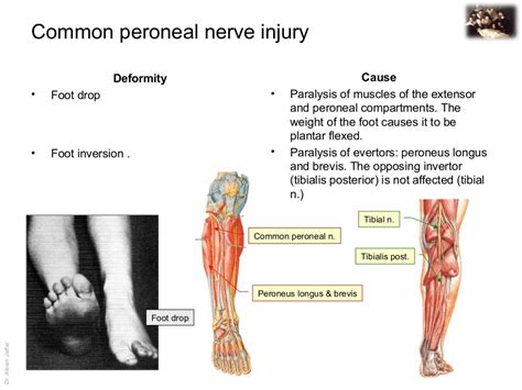 Femoral Nerve Injury Symptoms