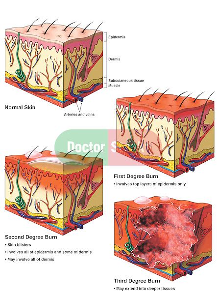 Classification Of Skin Burns Doctor Stock