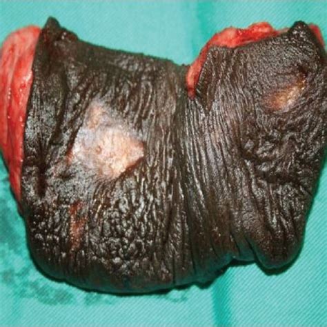 Post excision of penile shaft skin down to Buck's Fascia ...