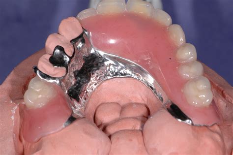 Full & Partial Dentures | Wiand Dental Lab - WiandLab.com