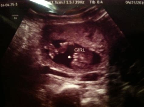 15 Weeks 3 Days Girl Ultrasound Pic