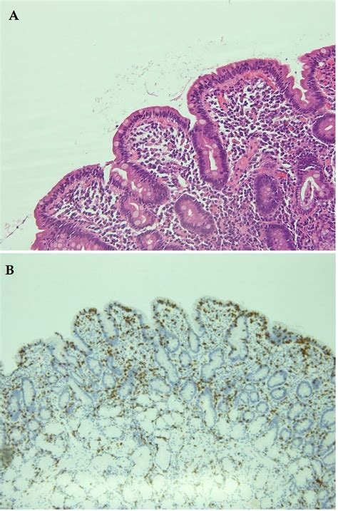 A Duodenal Biopsy Specimen Showing Flattening Of The Villous Download Scientific Diagram