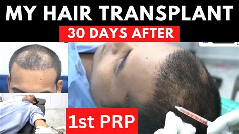 My First Prp After Hair Transplant Days After Hair Transplant