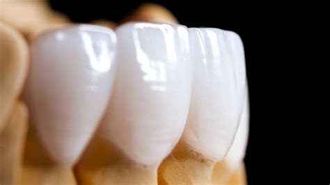 They found that the teeth whitened with strips once had less collagen and other proteins than the untreated teeth; How Long Do Dental Veneers Last? | Ivanhoe's Cosmetic Dentist
