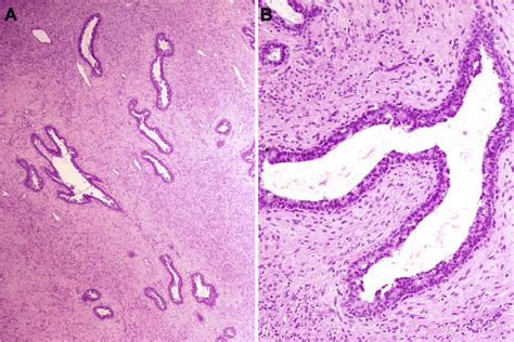 Microscopic Appearance Of The Fibroadenoma Arising In Ectopic Breast