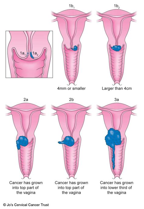Types And Stages Of Cervical Cancer Jos Cervical Cancer Trust