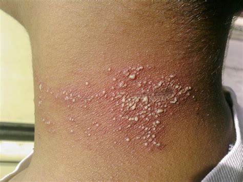 Bila dilakukan secara rutin, kemungkinan besar bintik putih pada bayi ini akan mengering dan mengelupas dengan sendirinya. Gambar Foto Hewan: gambar penyakit kulit akibat tomcat