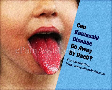 Can Kawasaki Disease Go Away By Itself