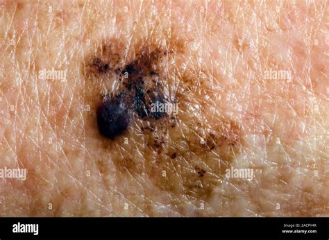 Close Up Of Skin Cancer A Superficial Spreading Melanoma Ssm On The