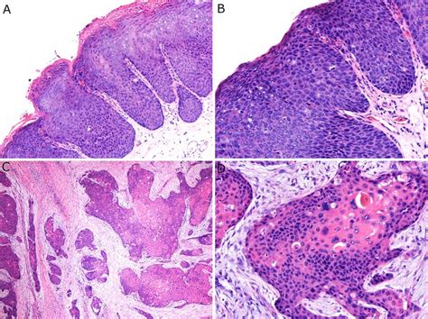 Morphologic Features Of Another Case Of Invasive Hpv Associated Scc