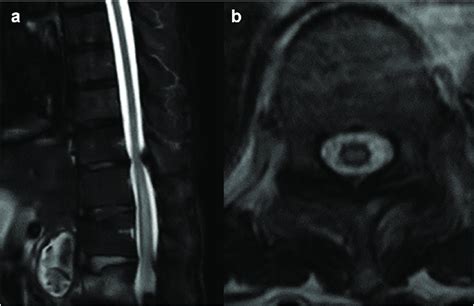 Sagittal A And Axial B Images Of T2 Weighted Magnetic Resonance