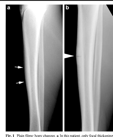 Stress Fracture Shin Mri Xchangebatman