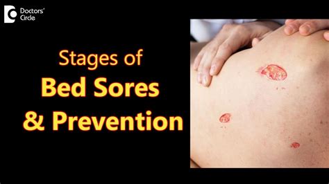Bed Sores Decubitus Ulcers Stages Causes Symptoms Treatment Dr Aruna Prasad Doctors