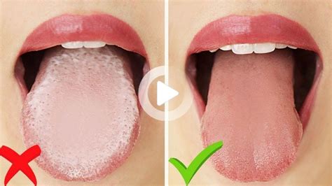 Self Care Tips And Home Remedies To Treat A White Tongue