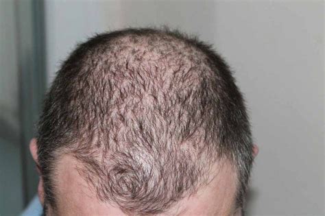 Understanding And Fixing Thinning Hair For Men Urbane Man