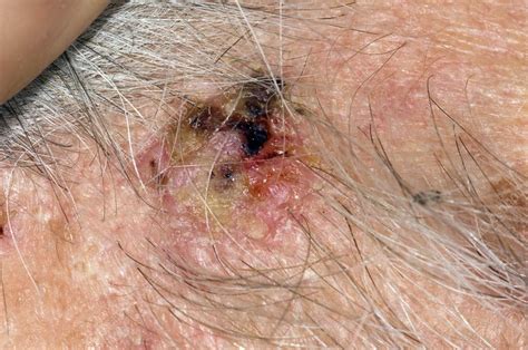 Basal Cell Skin Cancer On The Face Stock Image C0085709 Science