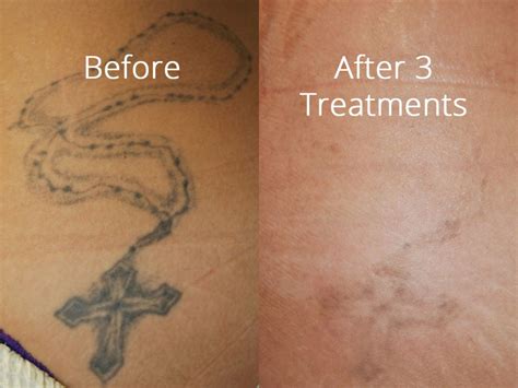 Tattoo Removal Before And After Salmon Creek Plastic Surgery