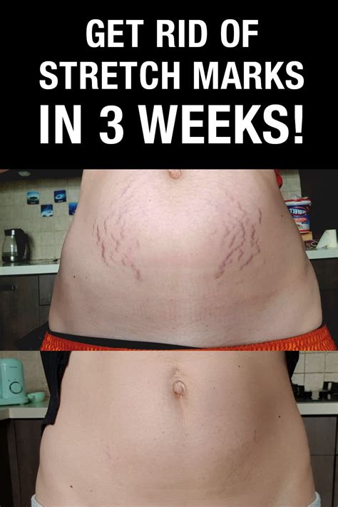 Stretch Marks On Stomach After Weight Loss Weighal