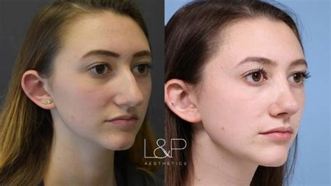 Young Bay Area Woman Gets Rhinoplasty From Facial Plastic Surgeons Dr Lieberman And Dr Parikh
