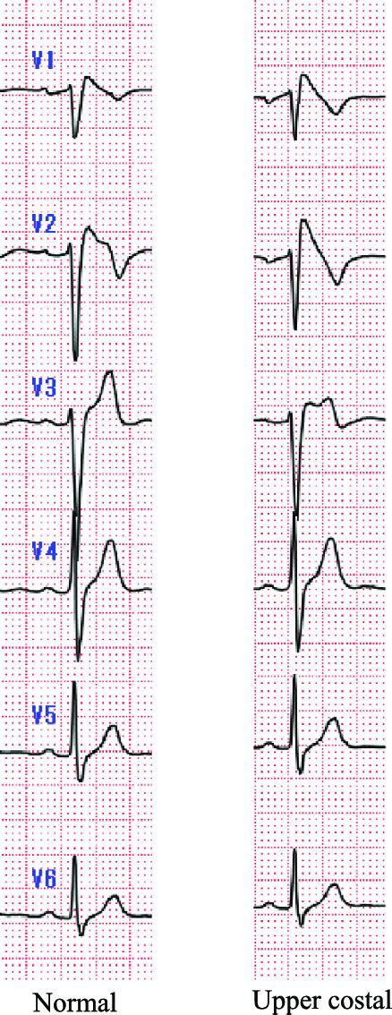 Precordial Ecg In A Patient With Brs In The Normal And Upper Costal