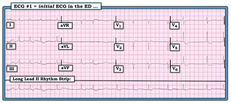 Dr Smiths Ecg Blog Why Is There St Depression In Avl In This Case Of 31b
