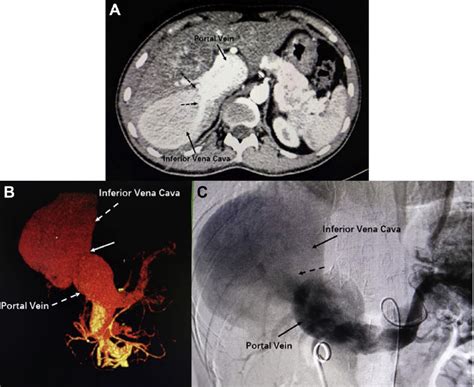 A Preoperative Abdominal Cect Shows Dilated Portal Vein Pv And