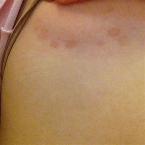 Skin Cancer Brown Circle Under Armpit Pictures 5 Common Summer Rashes