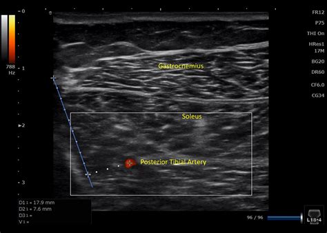 Ultrasonographic Validation For Needle Placement In The Tibialis