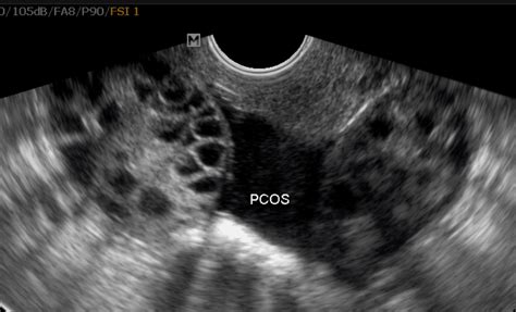 Nonvisualization of the ovaries on pelvic ultrasound: POCS ultrasound