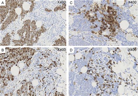 Prognosis and treatment of patients from a single institution. Immunohistochemistry of Merkel cell carcinoma metastases ...