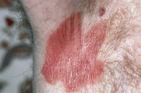 Erythrasma Skin Infection In Man S Armpit Stock Image M