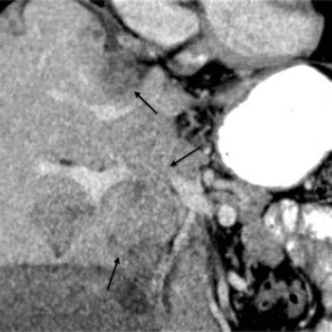 79 Year Old Man With Malignant Peritoneal Mesothelioma Of Epithelioid