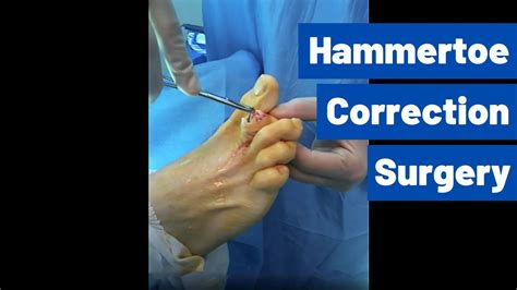 Hammer Toe Surgery Houston Foot Surgeon Dr Robert J Moore Iii Youtube