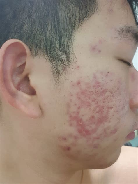 What Can I Do For Redness And Atrophic Scars After Completing A Course Of Accutane Photo Human
