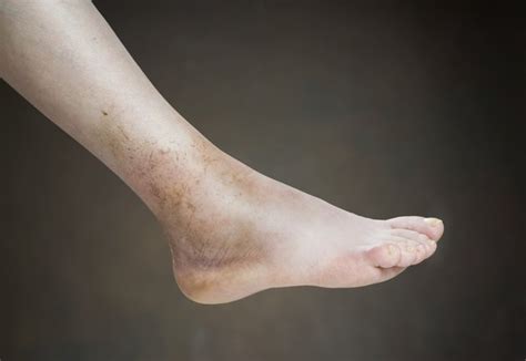 Causes Of Swelling In Legs Hands And Feet