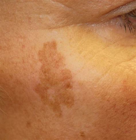 These Two Ingredients Will Help You To Get Rid Of Brown Spots On Your