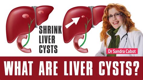 Liver Cyst Symptoms Natural Treatment Diet Supplements Is A