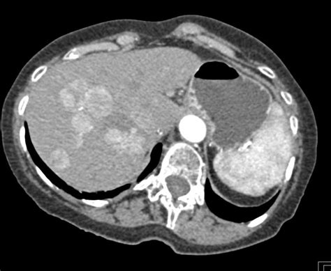 Liver Metastases From A Pancreatic Neuroendocrine Tumor Liver Case